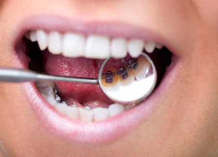 Lingual braces